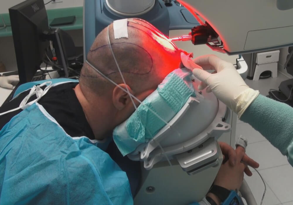 Robotic FUE
