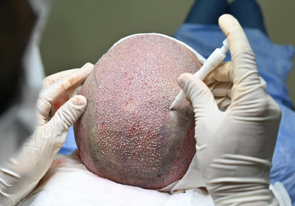 DHI (Direct Hair Implant)