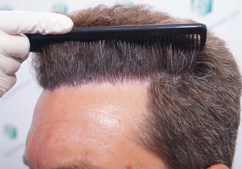 Unshaven Hair Transplant